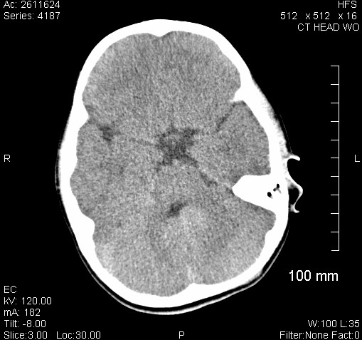 CT scan